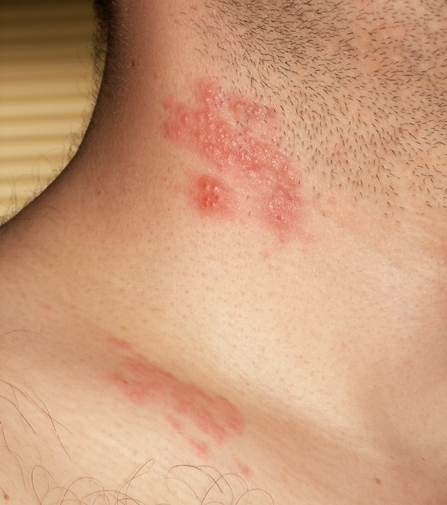 how long is shingles contagious after antibiotics
