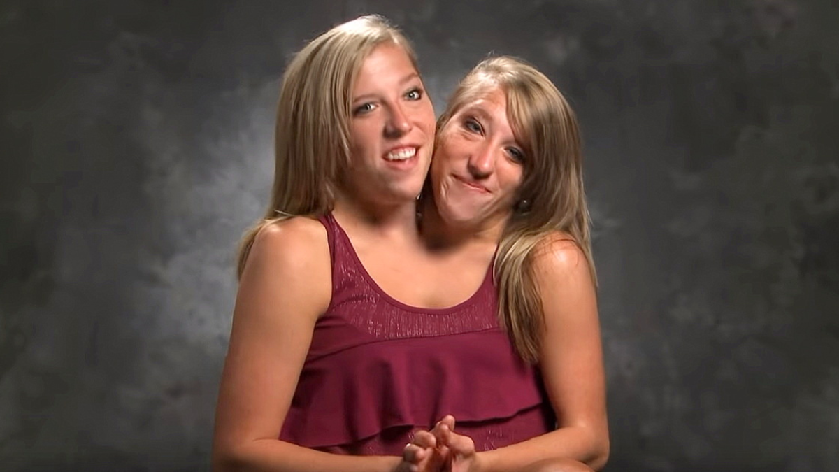 Abby and Brittany Hensel — See What the Famous Conjoined 